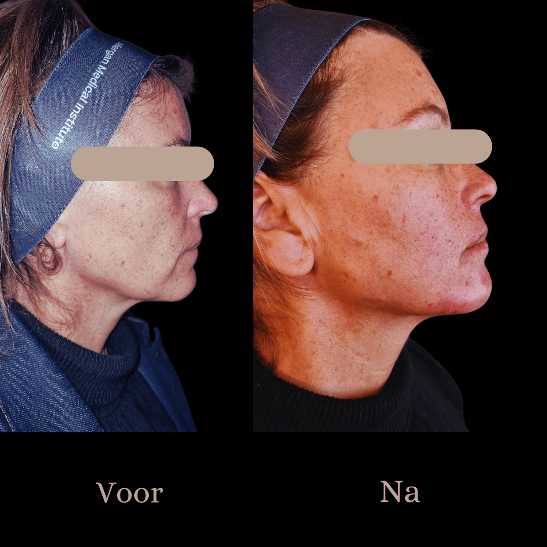 De 7-point-shape en de 9-point-shape,  de "niet-chrirurgische facelift" .