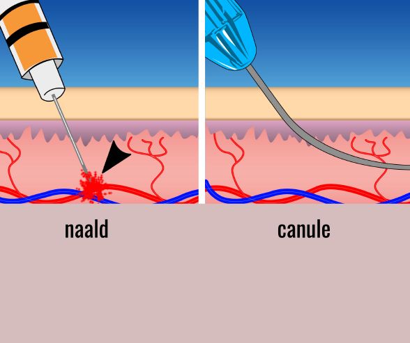 Wat is een canule?