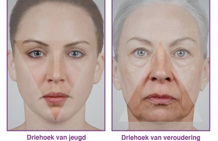 De 7-point-shape en de 9-point-shape,  de "niet-chrirurgische facelift" .