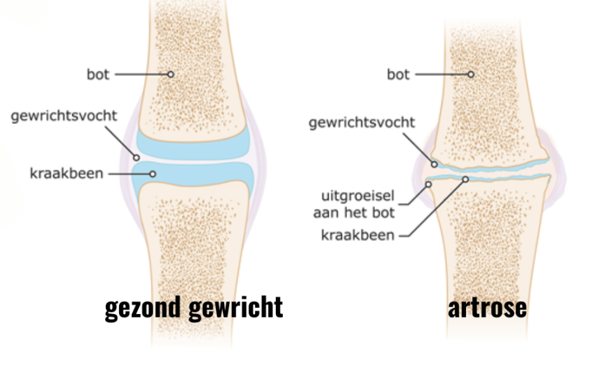 Pijnvrij bewegen bij artrose: innovatieve behandelingen met PRP en hyaluronzuur.